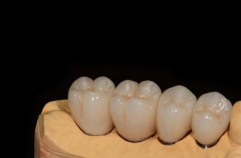 Noble Alloy Crown